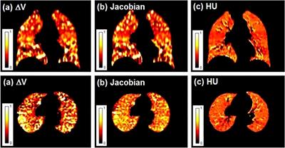 Functional lung imaging in thoracic tumor radiotherapy: Application and progress